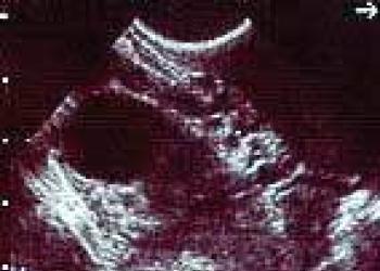 Четвертая неделя беременности: признаки и ощущения Беременность 4 5 недель ощущение симптомы